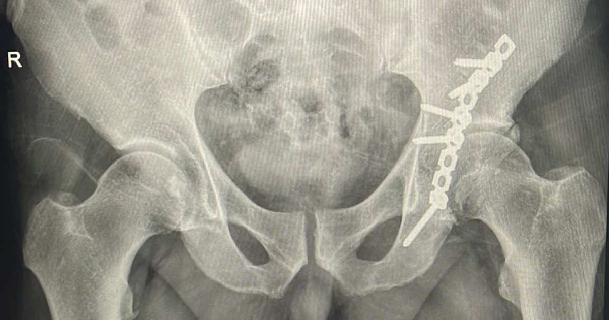 Komplex csípőízületi műtétet végeztek sikeresen a csíkszeredai kórházban